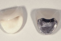 オールセラミックとメタルボンド