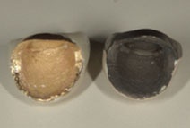 セラミック＋純金とレジン樹脂前装冠