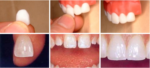 ラミネートベニア