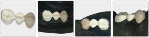 金属を使わないブリッジ(ジルコニアセラミックス)