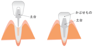 歯をかぶせる時、土台は何？